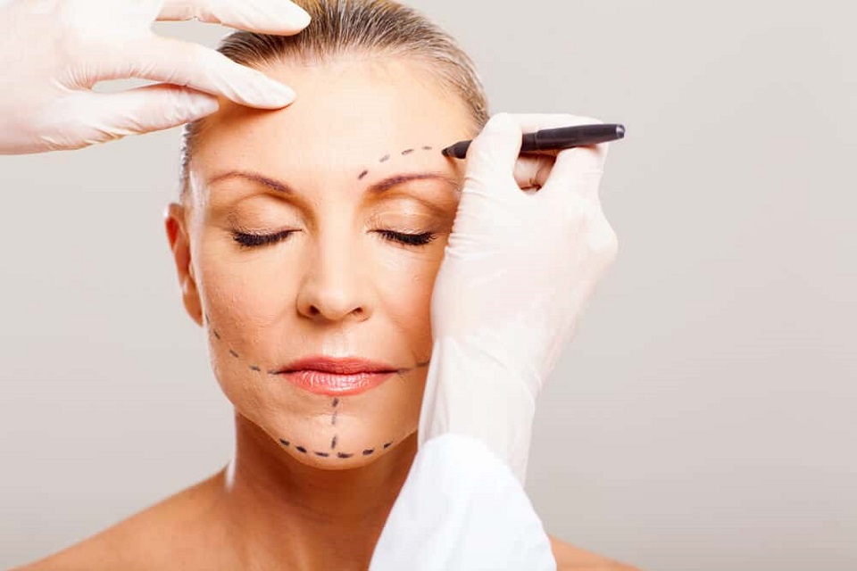 What You Should Expect When You Get A Face Lift