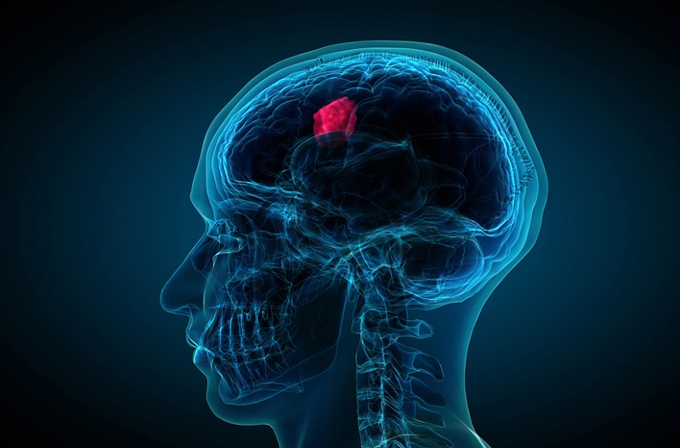Facts About Glioblastoma